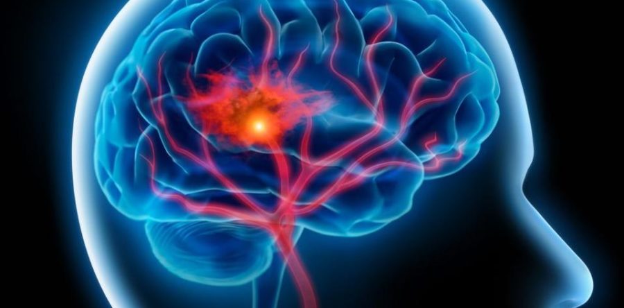 Rehabilitacja po udarze mózgu